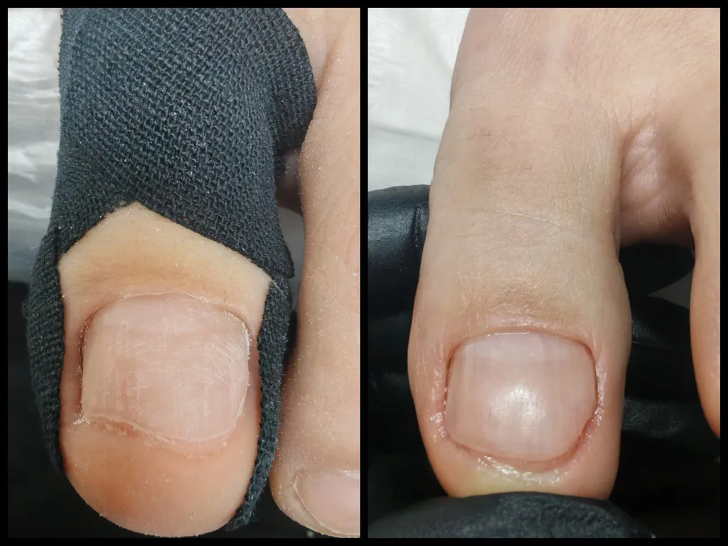 Unghia degetului mare cu pansament de protecție și după îngrijirea podologică